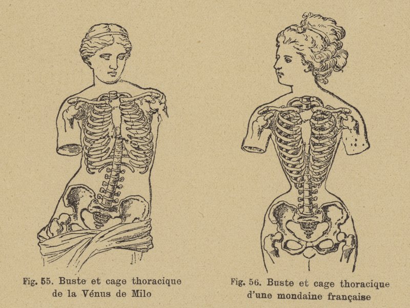 Jämförelse av formen på bröstet och bröstkorgen på Venus de Milo med formen på en fransk socialist från sent 1800-tal av German School