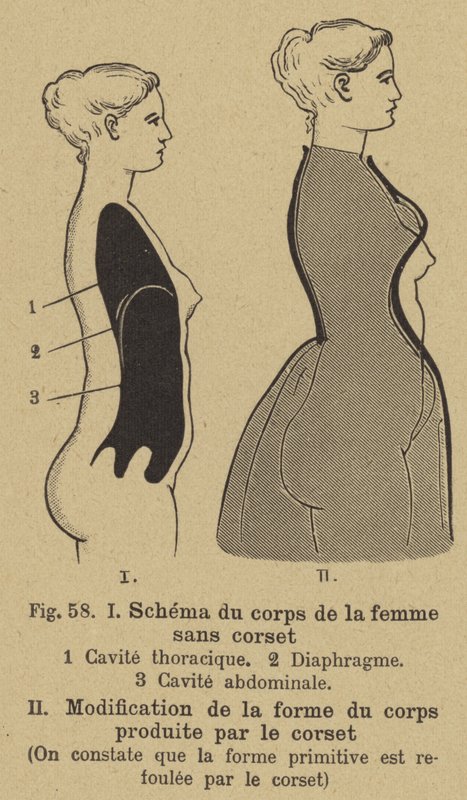 Diagram som visar effekten av att bära en korsett på formen av en kvinnas kropp av German School