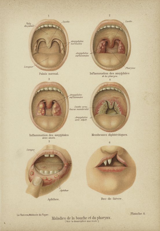Sjukdomar och störningar i mun och svalg (färg litho) av German School