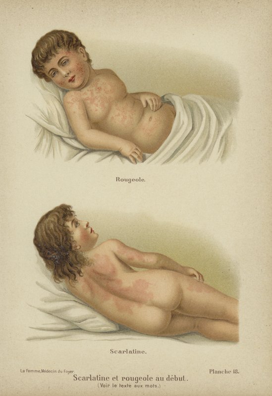 Tidiga symtom på mässling och scharlakansfeber (färg litho) av German School