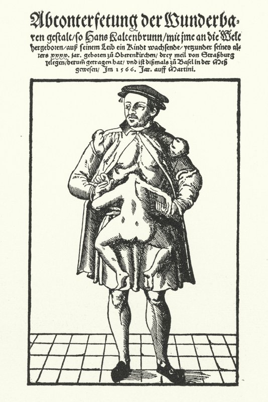 Hans Kaltenbrunn och hans outvecklade sammanfogade tvilling (gravyr) av German School