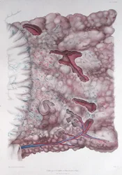 Epiploonens cancer, från 
