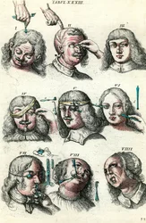 Kirurgi under det 18:e århundradet: trepanation och operation av ögat och ansiktet. Gravyr i ”Institutionis chirurgicae” av Lorenzo Heister