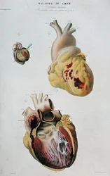 Tallrik föreställande hjärtsjukdomar. Spontan ruptur av hjärtat hos en 86-årig kvinna (fig. 1) och perikardit hos en sex dagar gammal baby (fig. 2), från 