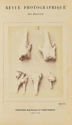 Multipla symmetriska exostoser, femur, tibia