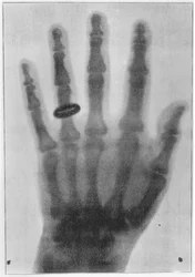 Röntgenbild av Anna Bertha Ludwigs, Röntgens hustrus, vänstra hand