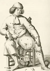 Dränering av vätska från en abscess av Frederik Dekkers, 1694
