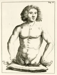 Exempel på medfödda missbildningar av Frederik Dekkers, 1694