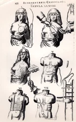 Operation av bröstcancer, ur Armamentarii Chirurgici av Johannes Schultes (1595-1645), utgiven i Amsterdam, 1672
