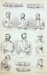 Tillfällig behandling av frakturer, c.1890