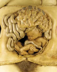 Anatomisk modell av en äggstocksgraviditet, detalj (vax) (se även 1126545-7)