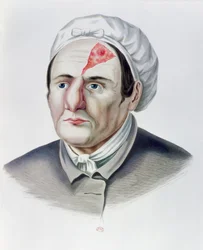 Efter en hudtransplantationsoperation, från Selecta Praxis Medico-Chirurgica av Alexander Auvert, Paris, 1856