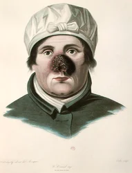 Före en hudtransplantationsoperation, från 