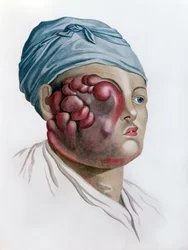 Cancerous scrofula, från Description des Maladies de la Peau av Baron Jean Louis Alibert (1768-1837) Paris, 1806