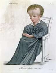 Intern Hydrocephalus, från Nosologie Naturelle av Baron Jean Louis Alibert (1768-1837) graverad av Tresca, 1817