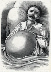 Patient med avancerad levercirros (gravyr) 1888