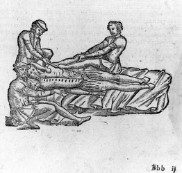 Reduktion av en dislokation, -i "Medical Treatise of Ambroise Paré", cirka 1560.