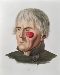 Hudsjukdom före en operation, från Selecta Praxis Medico-Chirurgica av Alexander Auvert, Paris, 1856