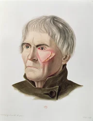 Hudtransplantatoperation, från Selecta Praxis Medico-Chirurgica av Alexander Auvert, Paris, 1856