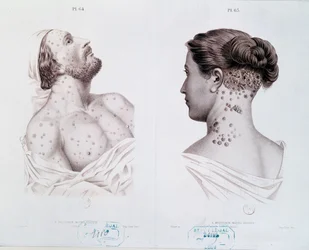 Symtom på syfilis hos män och kvinnor, ur en medicinsk bok, cirka 1850-60