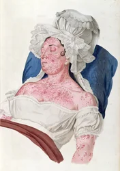 Kvinna med scharlakansfeber, från en bok av Baron Jean Louis Alibert (1768-1837) graverad av Choupard, 1833