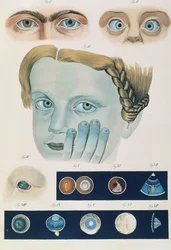 Beskrivning av medfödda ögonavvikelser, från kliniska presentationer av det mänskliga ögats sjukdomar och synfel, av Friedrich August von Ammon (1799-1861) 1838