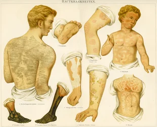 Hudsjukdomar, c.1890