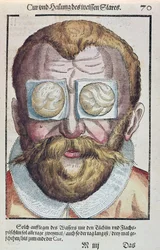 Treating an eye condition, från Ophthalmodouleia av Georg Bartisch (1535-1636) publicerad i Dresden 1583 (träblock i färg)
