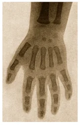 Röntgen av ett barns hand c.1890