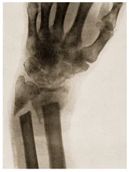Röntgen av en frakturerad handled ca 1890