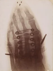 Foten genom skon, 1896.