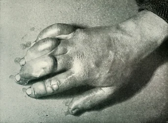 Dr. Atkinsons Frost-Bitten Hand, 5 juli 1911, 1913