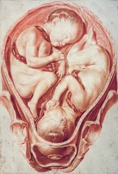Ms Hunter 654 Plate 10 Ritning från en uppsättning obstetriska teckningar för William Smellies (1697-1763) 