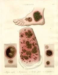 Patologiska hudtillstånd - Pityria;Impetigo och syfilis