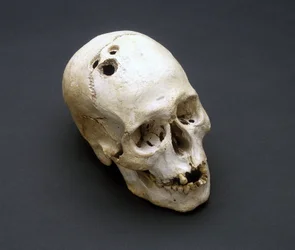 Trepanerat kranium från bronsåldern, Jeriko, Palestina, 2200-2000 f.Kr.