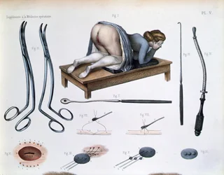 En operation på en vesikovaginal fistel, tallrik från 
