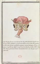 Tvärsnittsdiagram av en baby som dragits från livmodern med armen, från en bok av Madame Angelique Le Boursier du Coudray (1714-94) graverad av J. Robert, 1783
