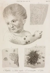Dermatologi Typer av hudsjukdomar