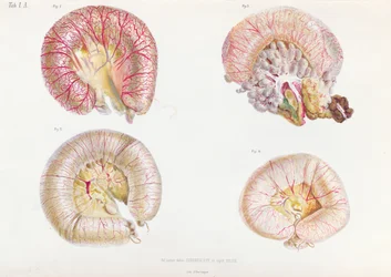 Den yttre ytan av tarmarna infekterade med kolera, från Anatomie Pathologique du Cholera Morbus, av Nikolai Ivanovich Pirogov (1810-81) publicerad i St. Petersburg, 1849
