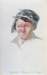 Syfiliska klusterpustler, från en bok av Baron Jean Louis Alibert (1768-1837) 1838