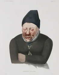 Sjukdomar, spetälska