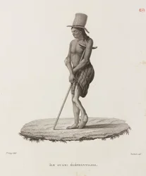 Sjukdomar, tropiska sjukdomar Man med elefantiasis, Guam