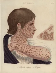 Measles and Rubeole - Litografi av John Pass, publicerad i "Encyclopedia Londinensis" av John Wilkes, utgåva J.Adlard, London