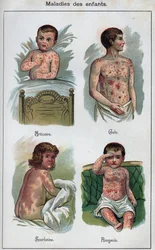 Sjukdomar hos barn: Nässelutslag, mässling, skabb, scharlakansfeber. I ”The new natural medicine”” av F.E. Bilz.