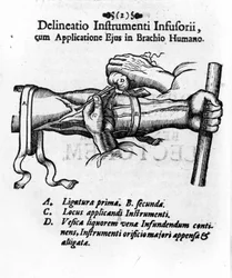 Intravenös injektion med hjälp av en blåsa. av J. D. Mayor, "" Surgery Infusoria "", Kilonii 1667