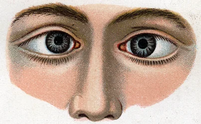Strabismus konvergerar. "Den nya naturliga medicinen" av F.E. Bilz.