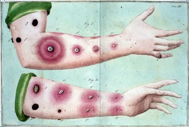 Symtom på smittkoppor som orsakar ett utbrott av varblåsor på huden. Medicinsk plansch ur "Avhandling om vaccination" av Luigi Sacco, Milano