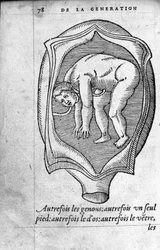 Fostrets position i livmodern under graviditeten. Gravyr från "" De la generation des enfants"" av den franska läkaren och kirurgen Ambroise Pare (1509-1590) 1500-talet