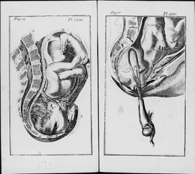 Födelse av ett barn med användning av pincett Platta från "An abridgement of the practice of midwifery"" av William Smellie (1697-1763)