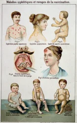 Plansch som illustrerar de olika formerna av syfilitiska sjukdomar och farorna med vaccination - i Bilz naturmedicin, slutet av 1800-talet.